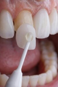 Instituto Volpe presenta Skin Finea®, carillas ultrafinas que preservan el diente propio al 100%