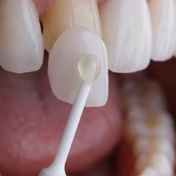 Instituto Volpe presenta Skin Finea®, carillas ultrafinas que preservan el diente propio al 100%